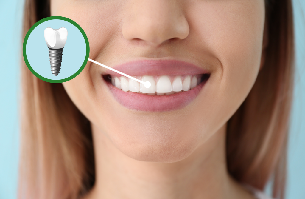 Dental Implants